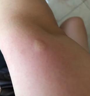 被蚊子咬了特别痒怎么办